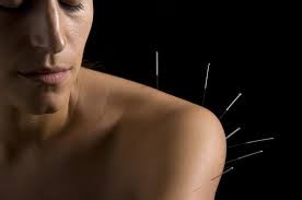 acupuncture for shoulder, neck, back pain, castle rock co