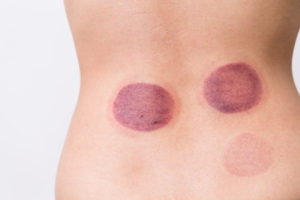 cupping marks, cupping bruises, cupping massage therapy, colorado natural medicine, acupuncture 