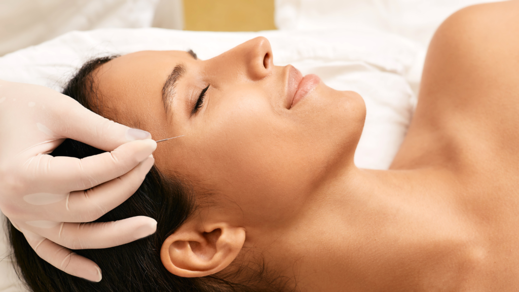 Microneedling treatment at Colorado Natural Medicine + Acupuncture in Castle Rock, Colorado offering Aesthetic Acupuncture including nanoneedling, constitutional facial acupuncture, and microneedling treatments